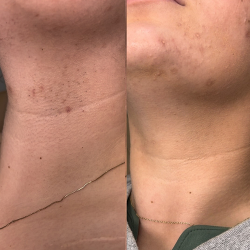 SmoothFace™ Trimmer 2.0